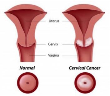 cervical-cancer.jpg