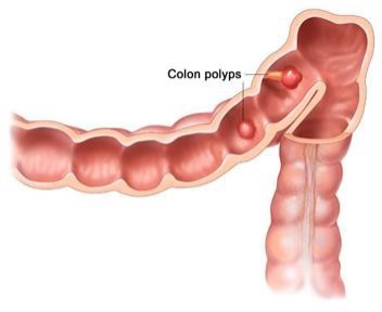 colon-polyps.jpg
